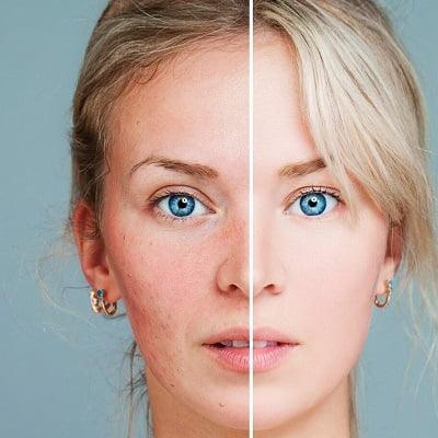 Price of Acne Scars Treatment in Islamabad