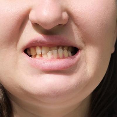 Can I Push My Protruding Teeth Back