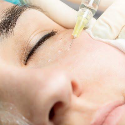 Can you use Botox under your eyes
