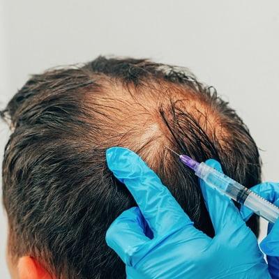 Does PRP on crown area really works