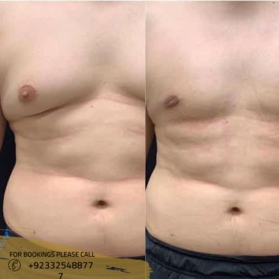 Does the skin tighten after gynecomastia surgery