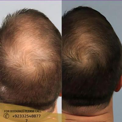 How Long Will Hair Shedding Last after PRP
