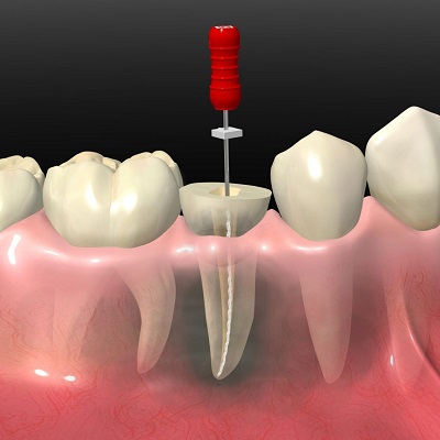 Will bad breath go away after root canal