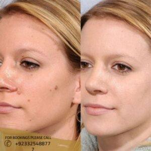 Skin Tag Removal in Islamabad Pakistan - ERC