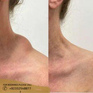 lipoma treatment fatty tumor results - ERC