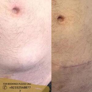 lipoma treatment in islamabad - ERC