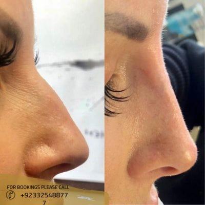 liquid rhinoplasty