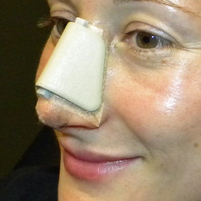 what happens if I don't tape my nose after rhinoplasty