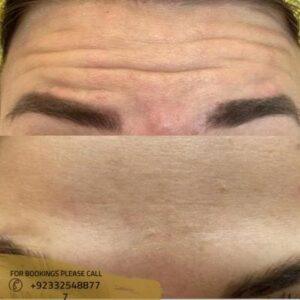 wrinkle smoothing in Islamabad