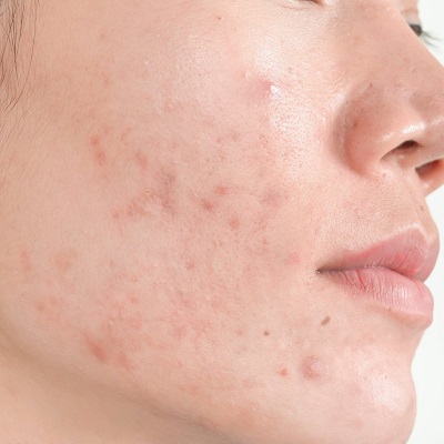 Acne Scar Removal Cost in Islamabad