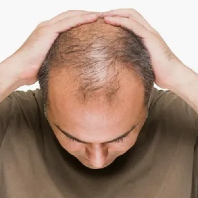 Can Hair Transplant in Islamabad Cure Genetic Baldness?