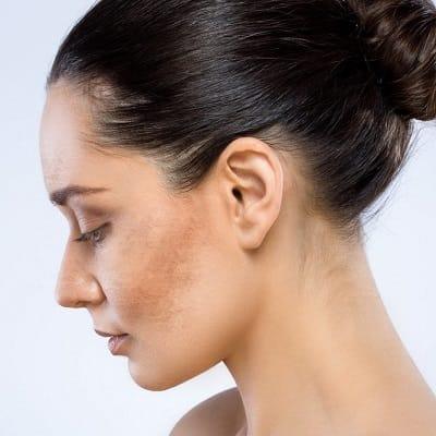 Can Melasma Recur After Treatment