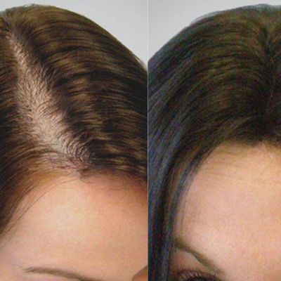 Can females get hair transplants in Islamabad