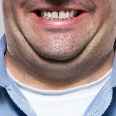 Non-surgical ways to lose double chin in Islamabad