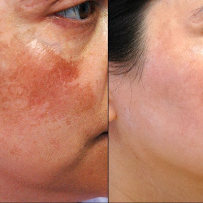 PICO Laser For Pigmentation in Islamabad