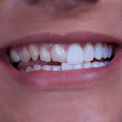 Top 4 appearance problem dental veneers can treat
