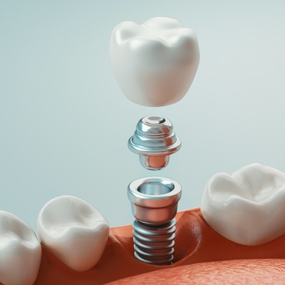 What is the healthiest dental implant in Islamabad