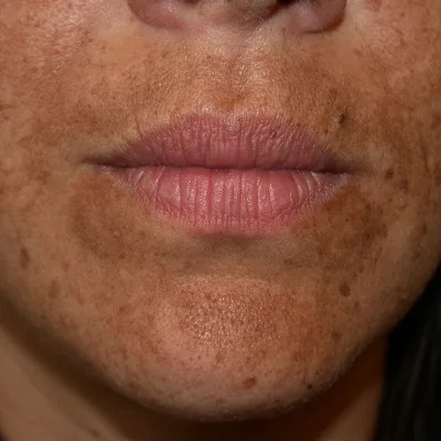 What is the permanent treatment for melasma in Islamabad?