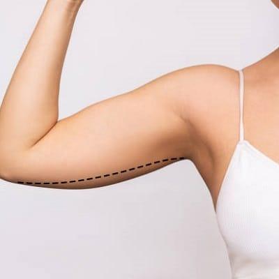 Arm Lift Surgery Cost in Islamabad