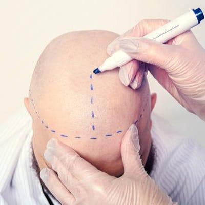 Can I Get an Infection After a Hair Transplant?