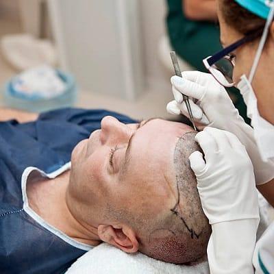 Can You Dye Your Hair After A Hair Transplant?