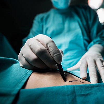 Cheap Liposuction Surgery Cost in Islamabad Pakistan
