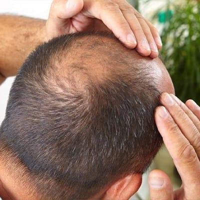 Does Crown Hair Transplant Grow Slower?