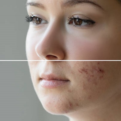 Does Glutathione Heal Acne and Acne Scars