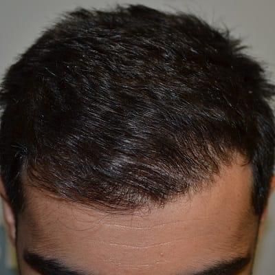 How Much Does 1500 Grafts Hair Transplant Cost in Islamabad Pakistan