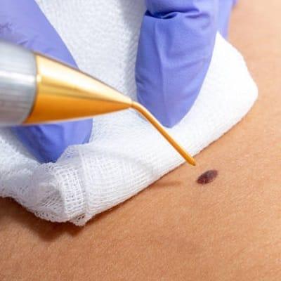 How can you stop warts from growing?