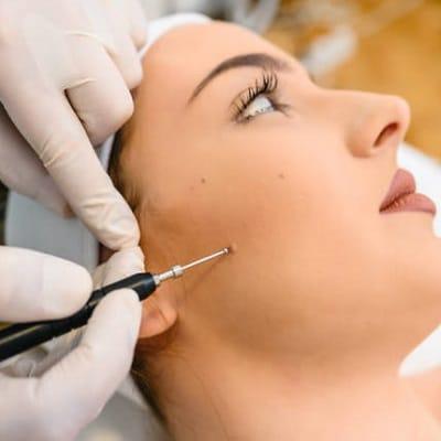 Do moles grow with age?