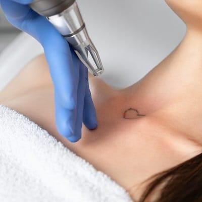 Does Laser Tattoo Removal Hurt?