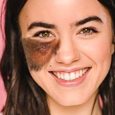 How Can You Remove Birthmarks from Face?