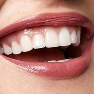 Why Bite Correction is Important in Islamabad, Pakistan?