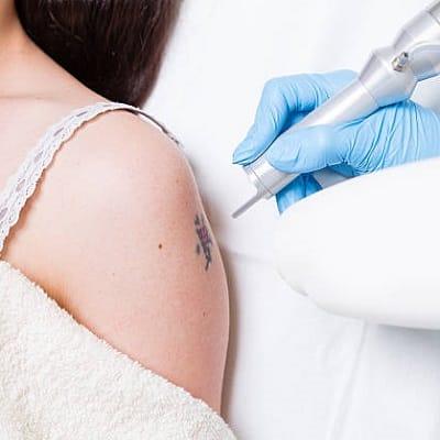 Are Newer Tattoos Easier To Remove?