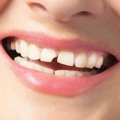 How Will Be My Fractured Tooth Treated?