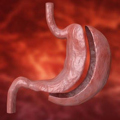 Will I have loose skin after bariatric surgery?