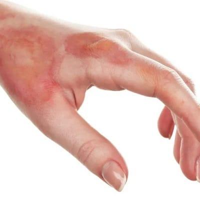 Burn Reconstructive Surgery