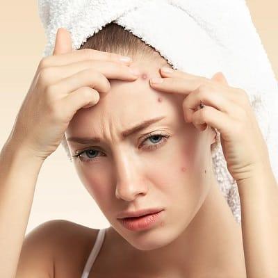 Laser Acne Treatment