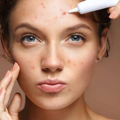 Pimples Treatment in Islamabad