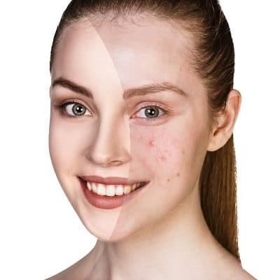 Can acne scar treatments damage my skin barrier?