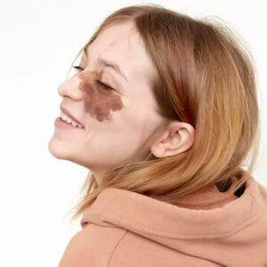 How Much Does Birthmark Removal Cost?