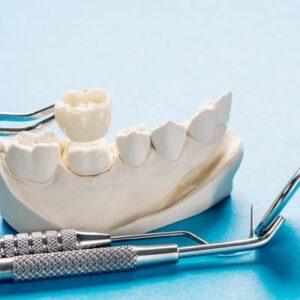 How Much Is the Teeth Cap Price in Pakistan?