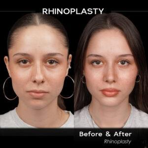 rhinoplasty before and after