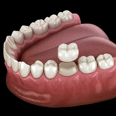 What to Do When A Dental Crown Is Loose?