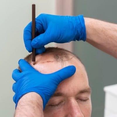 Can I travel after a hair transplant?