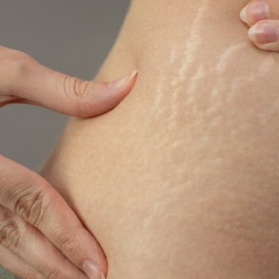 Average Cost of Laser Stretch Mark Removal
