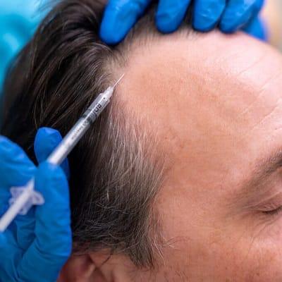 Does PRP hair treatment work