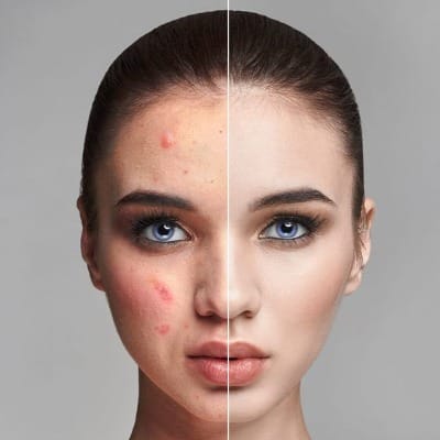 Facial Scar Treatment After Surgery