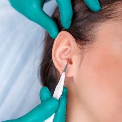 What Is the New Technique for Otoplasty